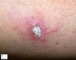 Cutaneous leishmaniasis
