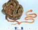 Neonatal meconium ileus with functionnal microcolon in cystic (...)