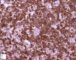 CD3 in mixed cellularity Hodgkin lymphoma