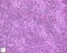 mixed cellularity Hodgkin lymphoma
