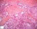 Mucoepidermoid carcinoma