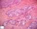 Mucoepidermoid carcinoma