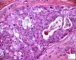 Mucoepidermoid carcinoma