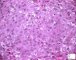Mucoepidermoid carcinoma