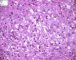 Mucoepidermoid carcinoma