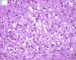 Mucoepidermoid carcinoma