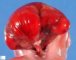 Posterior encephalocele