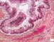 Glandular tissue in immature ovarian teratoma (6 years)