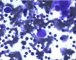 Parvovirus B19 cytopathogenic effect in bone marrow