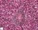 Periportal hematopoiesis (32 weeks) - Etiology unknown