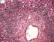 Periportal hematopoiesis (32 weeks) - Etiology unknown
