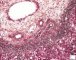Periportal hematopoiesis (32 weeks) - Etiology unknown