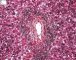 Periportal hematopoiesis (32 weeks) - Etiology unknown