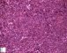 Precursor B lymphoblastic lymphoma