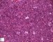 Precursor B lymphoblastic lymphoma