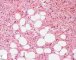 Subcutaneous desmoid fibromatosis