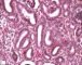 Renal tubular dysgenesis