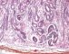 Renal tubular dysgenesis