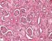 Renal tubular dysgenesis