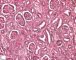 Renal tubular dysgenesis