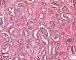 Renal tubular dysgenesis