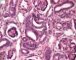 Renal tubular dysgenesis
