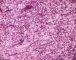 Xanthogranulomatous reaction in osseous Langerhans histiocytosis