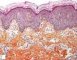 Epidermal nevus with melanocytosis