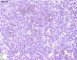 Alpha-FP on the embryonal component of an epithelial hepatoblastoma
