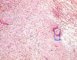 Zoonotic north american Brugia