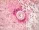 Cutaneous north american brugiasis (cutaneous filariasis)