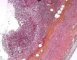 Acute appendicitis