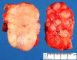 Adrenal maturing ganglioneuroma