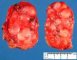 Adrenal maturing ganglioneuroma