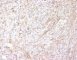 ALK immunolabelling in myofibroblastic inflammatory tumor