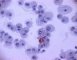 Lipophages in alveolar lavage