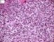 Bone marrow localization of classic Hodgkin lymphoma