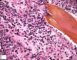Bone marrow metastasis of a neuroblastoma