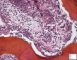 Bone marrow metastasis of a neuroblastoma