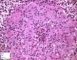Epitheloid cells in epithelioid granuloma (chalazion)