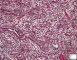Candida fetal pneumonitis