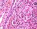 Nuclear and cytoplasmic inclusions in CMV fetopathy