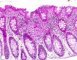Colonic tuberculoid granuloma