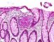 Colonic tuberculoid granuloma