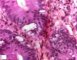 Colonoc GVHD