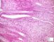 Colonic localization of an infantile myofibromatosis