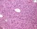 Congenital fibrosarcoma