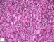 Acute inflammation with granulocytic diapedesis in ileal Crohn (...)