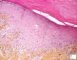 Cutaneous GVH