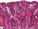 Intestinal cystic fibrosis